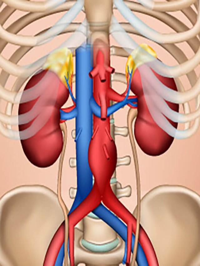 รายการ 98+ ภาพ abdominal aortic aneurysm อาการ ใหม่ที่สุด
