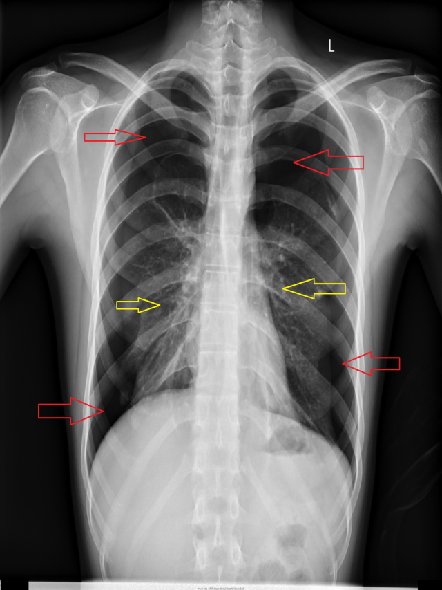 อันดับหนึ่ง 90+ ภาพ pneumothorax พยาธิสภาพ อัปเดต